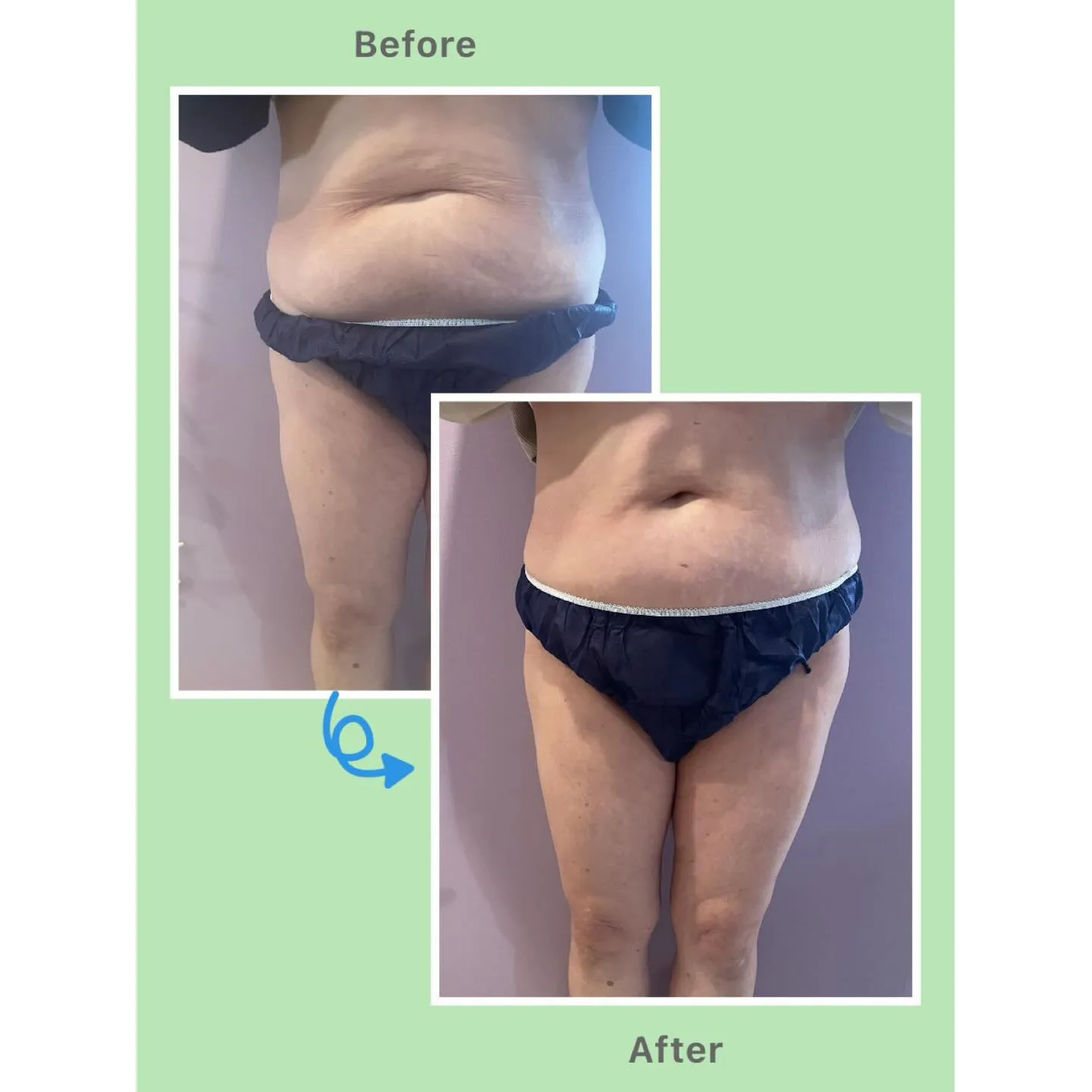 40代からの痩身は